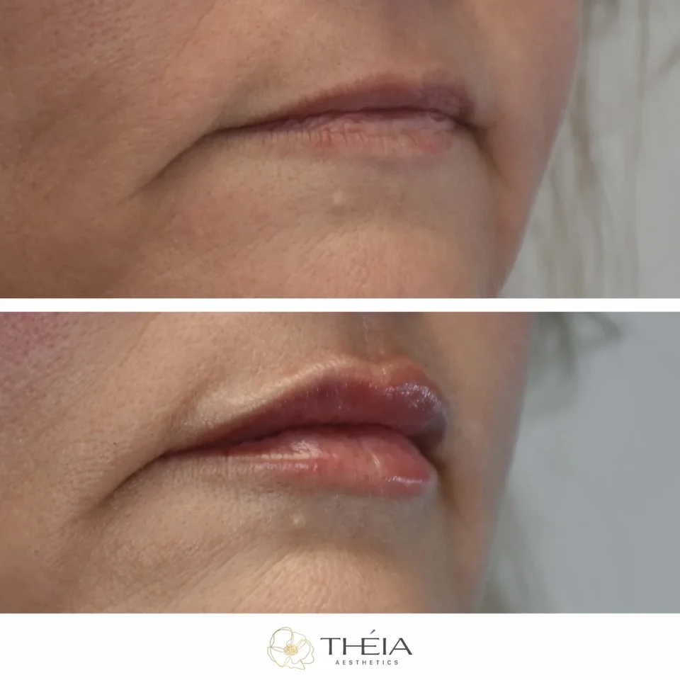 before and after photo of lip filler