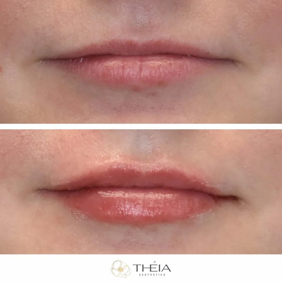 before and after photo of lip filler