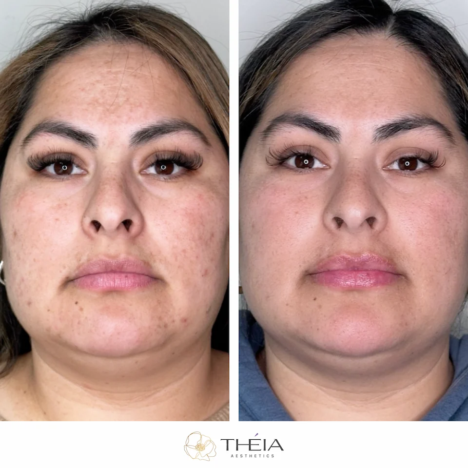 Before and After photos of BioRePeel treatment at Theia